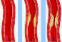 Фото атеросклеротических изменений. Сайт: Ионизаторы воздуха (Люстры Чижевского) Аэроион-25